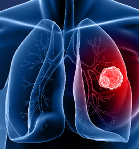 Blood test technology detects lung cancer with 90% accuracy