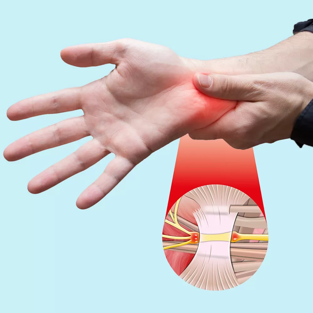 Carpal Tunnel Surgery in Iran | Best Surgeon & Hospital